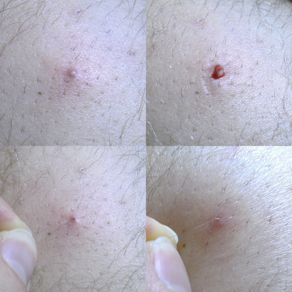 Alles over ingegroeide haren! Hoe kun je ze voorkomen? Haarverliesstoppen.nl
